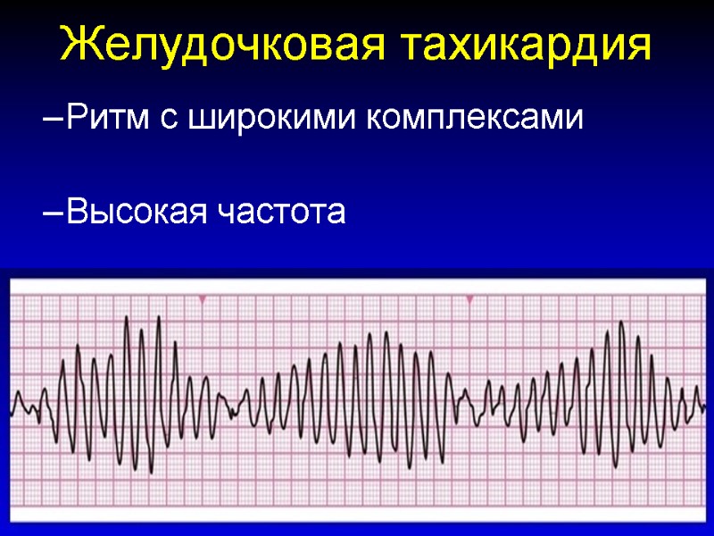 Желудочковая тахикардия Ритм с широкими комплексами  Высокая частота